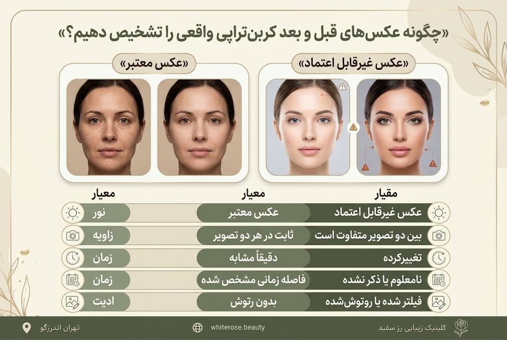 عکس قبل و بعد کربن تراپی صورت