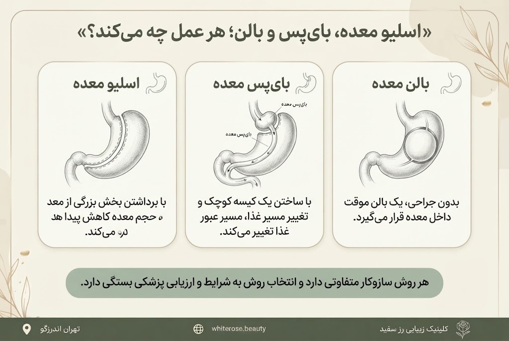 عوارض اسلیو، بایپس یا بالن معده؛ راهحلهای زیبایی برای بعد از عمل