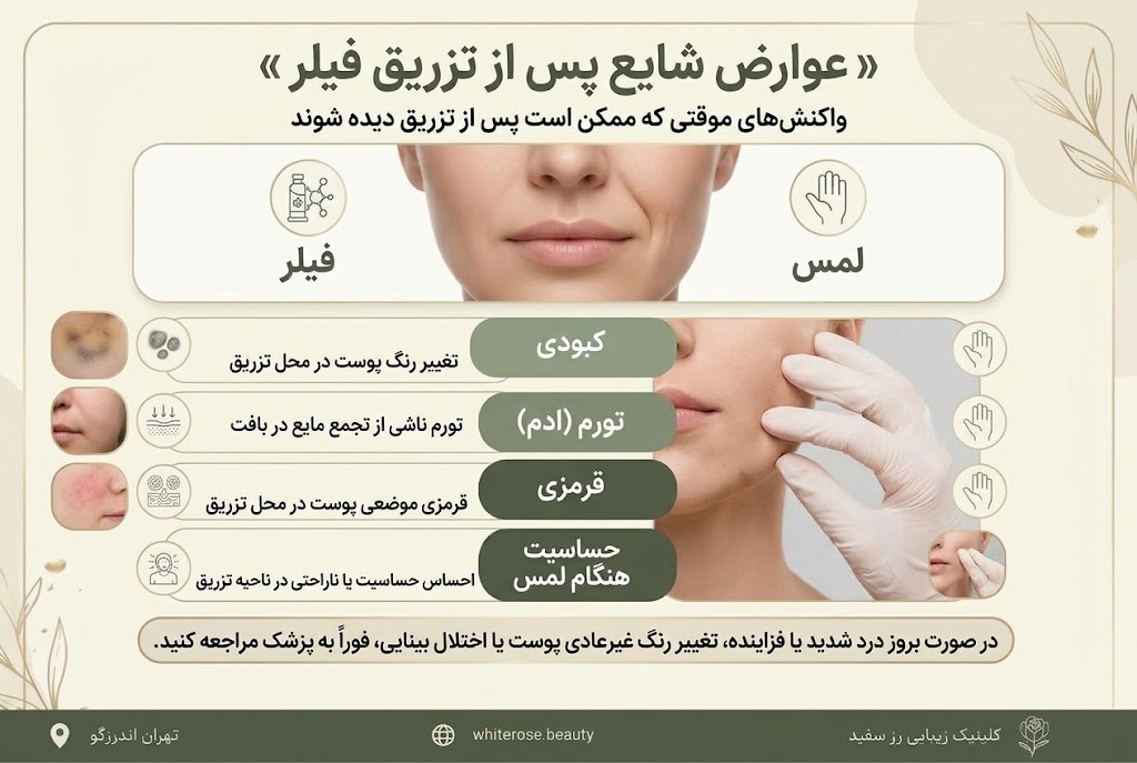 از بین بردن چروک زیر چشم با فیلر